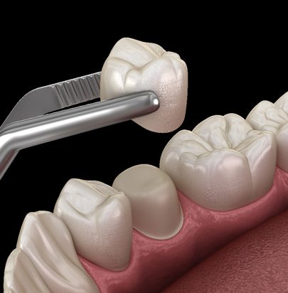 Crowns - Gloucester Street Dental