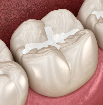 Fillings - Gloucester Street Dental