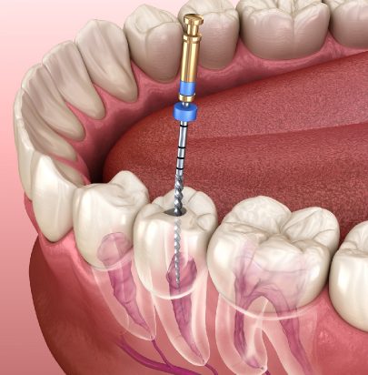 Root Canal Treatment - Gloucester Street Dental