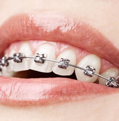 Cosmetic Braces - Gloucester Street Dental