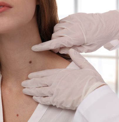 Skin Tag Removal - Gloucester Street Dental